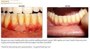 Can Receding Gums Be Reversed Care Com