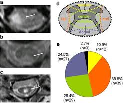 Loss of myelin often leads to spinal cord scarring that blocks nerve impulses and. Diagnostic Workup Of Patients With Acute Transverse Myelitis Spectrum Of Clinical Presentation Neuroimaging And Laboratory Findings Spinal Cord