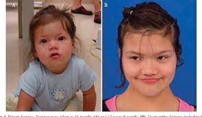 An abnormally long vertical groove in the center of the upper lip (philtrum); Figure 4 From Combined Pituitary Hormone Deficiency In A Girl With 48 Xxxx And Rathke S Cleft Cyst Semantic Scholar