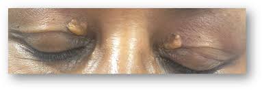 Image result for xanthelasma of eyelid