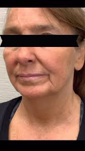 This guest was brand new to filler and just wanted to see if we could  improve the pesky marionette lines making her look sad. , Mission  accomplished!💉😉, #filler #mychapterstudio #medspa #injectables ...
