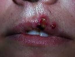 Neonatal herpes simplex virus (hsv) infection has a high morbidity and mortality rate. Herpes Simplex Dermnet Nz