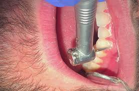 In europe braces are used in place of a belt to hold your trousers up. How Are Braces Removed Premier Orthodontics