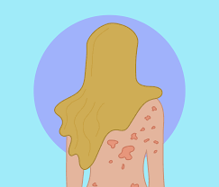Hominis, que é um ácaro. Escabiose Como Diagnosticar E Tratar Corretamente Blog Jaleko