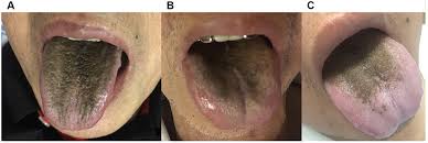 Image result for black hairy tongue symptoms