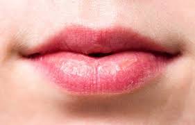 Image result for Angular Stomatitis