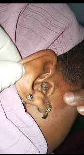 Image result for Myiasis