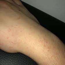 Check spelling or type a new query. Ausschlag Entzundung Gesundheit Und Medizin Gesundheit Medizin