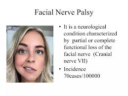 Facial nerve palsy
