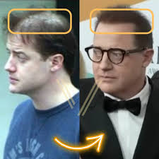 Brendan Fraser Hair Transplant: Before and After Transformation