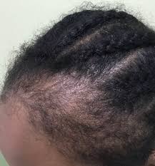 If you are facing severe signs of traction alopecia, you need to consult your doctor immediately. Cicatricial Twitter Search