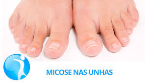 Eliminar a coceira entre os dedos; Micose De Unha Onicomicose Como Acabar Rapido Com Ela Minha Vida