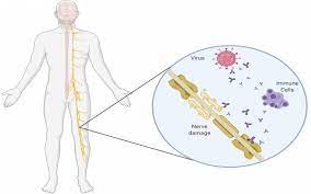Willison h.j., jacobs b.c., van doom a.p. No Association Between Covid 19 And Guillain Barre Syndrome Ucl News Ucl University College London