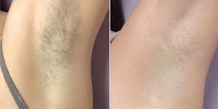 Is laser hair removal painful? Laser Hair Removal Kuala Lumpur Malaysia Cost Reviews Benefits Nexus Cllinic