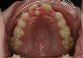 Check spelling or type a new query. Mesiodens Supernumerary Tooth Hyperdontia Bauer Smiles