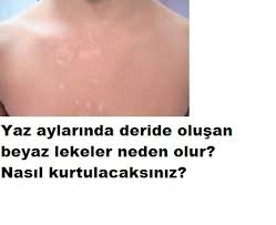 Beyaz Lekeler Icin Dogal Tedavi Ciltte Ozellikle Yaz Aylarinda Olusan Beyaz Lekeler Nedir Ve Tedavisi Nasil Olur Homemade Skin Care Tattoo Quotes Skin Care