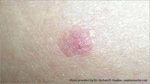 It frequently develops on the legs of women and on the chest, back, head, and neck of men. Skin Cancer Pictures Photos Pictures Of Skin Cancer