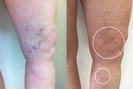 Image result for Pigment stains on the shin