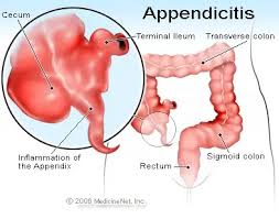 Image result for Appendicitis