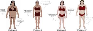 Image result for Lipodystrophy