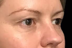 Primarily used by east asian internet users to express rage, the emoticon became popular among western internet users following its introduction through internationally. Eyelid Reduction Dr David Sharp Blepharoplasty