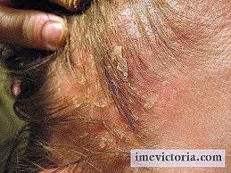 Behandling a seboreisk eksem oppstår under en akutt episode og perioden mellom to sykdommer. Effektive Midler For Seboreisk Dermatitt No Imevictoria Com