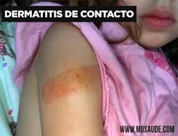 Image result for dermatitis contacta allergica