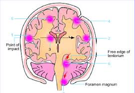 Image result for Contusion
