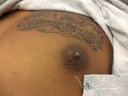 Image result for Galactorrhea