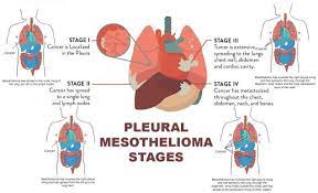If you have signs and symptoms that might indicate mesothelioma, your doctor will conduct a physical exam to check for any lumps or other unusual signs. Pin On Mesothelioma