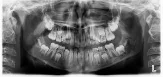 Panoramic Taken On Our Office On A 10 Year Old Child Showing Permanents As Well As Primary Teeth Unerupted Dental Treatment Dental Clinic Dental