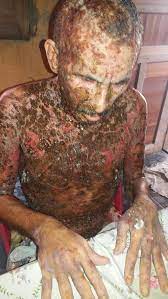 A) the disease occurs in endemic fashion in regions of brazil within the states of goias, mato grosso do sul, parana, sao paulo, and minas ge … Ajuda Seu Antonio Doenca Fogo Selvagem Vaquinhas Online