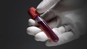 Researchers have been working to develop tests that can detect bits of tumor material in bodily fluids such as blood or urine. Things Your Doctor Won T Tell You About Your Blood Test Results Everyday Health