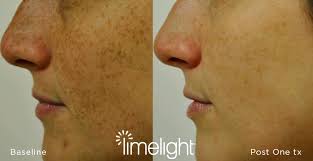 Treatment wise it was totally painless. Ipl Light Facial Treatments Accent Aesthetics