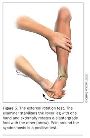 Image result for Ankle External Rotation Test