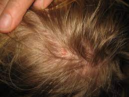 ما هي أسباب ظهور قمل الرأس وكيف تتخلص من الصيبان طب تايم