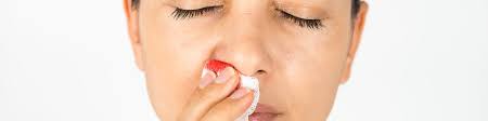 Epistaxis Mcgovern Medical School