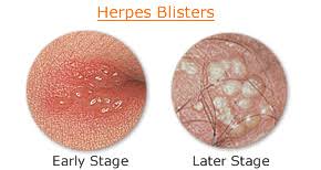 Sexual network drivers of hiv and herpes simplex virus type 2 transmission. aids (london, england) 31.12 (2017): Straight No Chaser 10 Questions You Want Answered About Genital Herpes Jeffrey Sterling Md