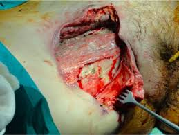 Other types of bacteria that can cause necrotizing fasciitis include klebsiella, clostridium, and. Necrotizing Fasciitis Concise Medical Knowledge