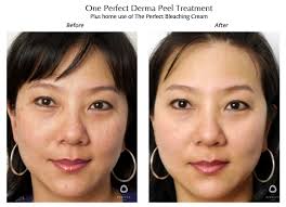 Chemical peel before and after. Https Www Theperfectdermapeel Com Perfect Skin Can Be Yours