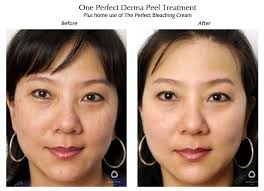 Https Www Theperfectdermapeel Com Perfect Skin Can Be Yours