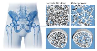 Was Ist Osteoporose