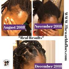 Inexpensive but effective, this wild hair growth oil is a hair regrowth treatment that nourishes the scalp and hair. Wild Growth Oil For Adults And Kids Natural Hair Styles Wild Growth Oil Natural Hair Care