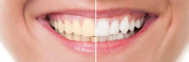 All about temporary fillings cavities, or tooth decay, can form as the result of frequently consuming sugary foods and drinks, not brushing or a dental filling can replace parts of a damaged tooth and prevent further decay. How Effective Are Teeth Whiteners Consumer Nz