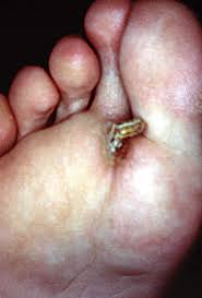 Image result for cornu cutaneum)