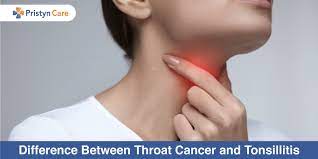 Symptoms of advanced tonsil cancer can include: Difference Between Throat Cancer And Tonsillitis Pristyn Care