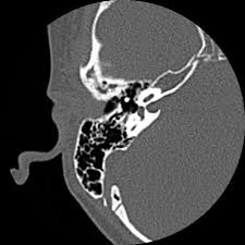 Image result for Ossicular Chain Disruption