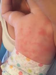 Ausschlag Im Body Bereich Forum Baby Urbia De