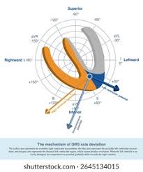 Image result for Left Axis Deviation