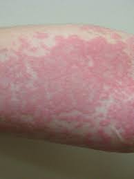 Untuk mengatasi infeksi tinea, anda dapat mengoleskan krim antijamur atau mengonsumsi obat antijamur dalam bentuk tablet. Waspada 6 Jenis Ruam Kulit Ini Ternyata Pertanda Penyakit Serius Global Liputan6 Com